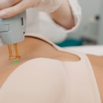 Laser Hair Removal for the Bikini Line: A Comprehensive Guide